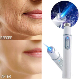 Acne Wrinkle Removal Laser Pen Skin Spots Removal Blue Light Therapy